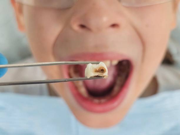 Best Tooth Infection Emergency Dentist  in Wallace, ID